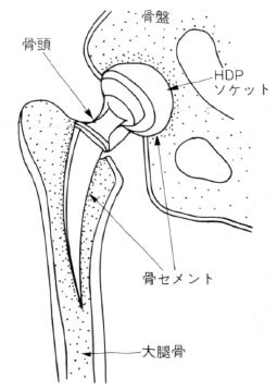 人工股関節の説明図